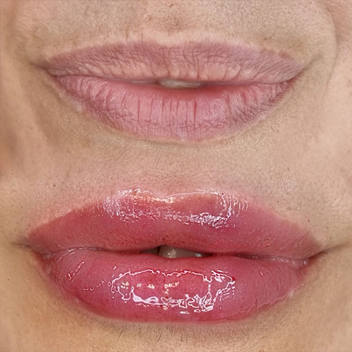 Preenchimento Labial 