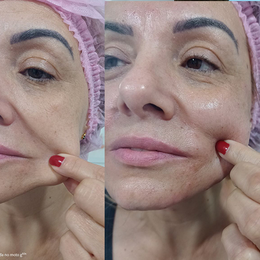 Flacidez Facial - Pele flácida devido à perda de Colágeno, estimulação para uma melhor qualidade de pele  