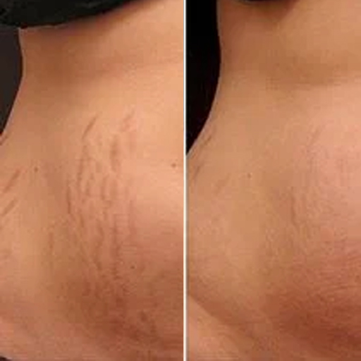 Estrias - Promover a redução das estrias para uma melhor aparência 