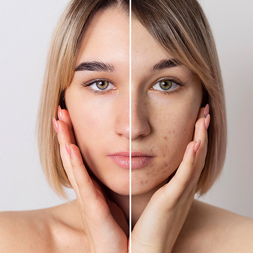 Acne - Promove a redução de cicatrizes proveniente do acne devolvendo uma melhor textura da pele. 