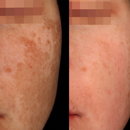 Tratamento usando a crioterapia em albufeira