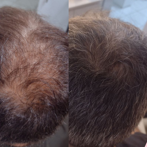 Tratamento Capilar são usados ativos para estimular o crescimento capilar