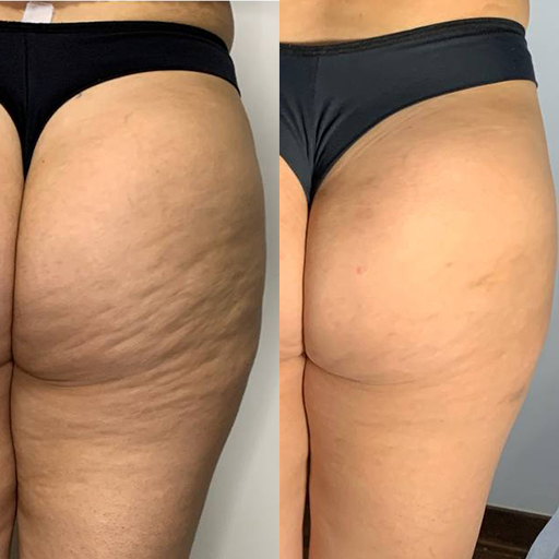 Up Glúteos - Aumentar e redefinição para um Glúteo mais harmonioso 